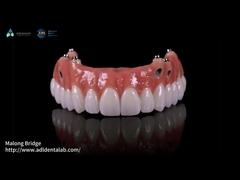 Composite Pink Porcelain Crown A1 Shade All On 4 Hybride Titanium Schroef behouden