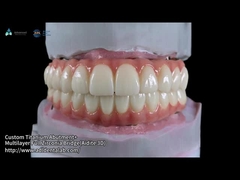Translucent Full Contour Zirconia Bridge Over Milled Implant Bar