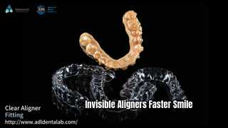 Onzichtbare aligners Snellere rechtere glimlach