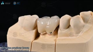 Veldspaatfineer Natural Smile Makeover Guide