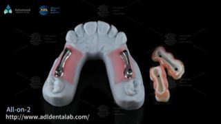 Premium titanium implantaatstaaf voor All On X Dentistry