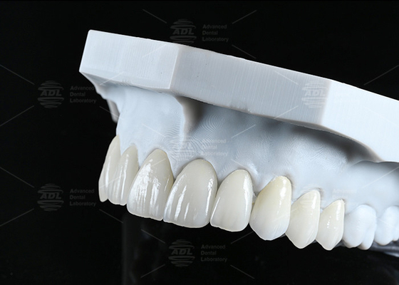 kopen Translucent CAD EMAX veneer gepolijst geglazuurd keramisch herstelwerk voor voorste achterste delen online vervaardiging
