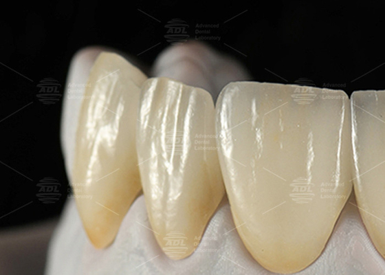 kopen 0.3mm-0.7mm Feldspatische EMAX Keramische veneers Natuurlijke Esthetische Emax Tandheelkundige veneers online vervaardiging