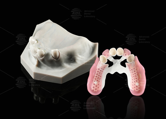 kopen Biocompatibiliteit Tandheelkundige Telescoop Wit Inner Zirconia Buiten Peek Telescoop Tandheelkundige online vervaardiging