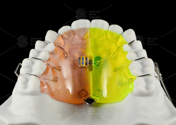 kopen Orthodontische ventilatorvormige expander zorgt voor achterste crossbite gratis sectie uitbreiding online vervaardiging