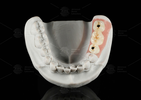 kopen Schroefhoudende titanium porselein, gesmolten met zirconia online vervaardiging