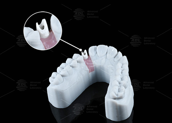 kopen Wit Custom Zirconia Abutment Natuurlijk uitziende esthetiek en optimale functionaliteit online vervaardiging