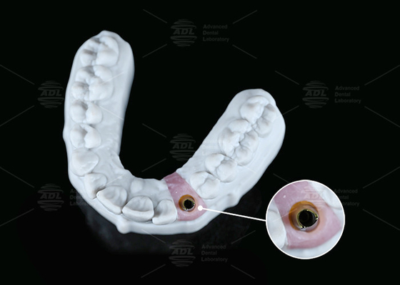 kopen Interne hex Custom Titanium Abutment Schroef Cement behouden Verschillende vorm online vervaardiging