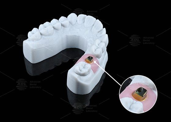 kopen Op maat gemaakte tandheelkundige implantaten en oplossingen tegen corrosie op basis van titanium online vervaardiging