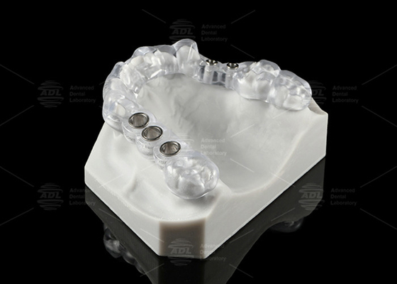 kopen Op maat gemaakte transparante tandheelkundige implantatenoplossing chirurgische stent ergonomisch ontwerp online vervaardiging