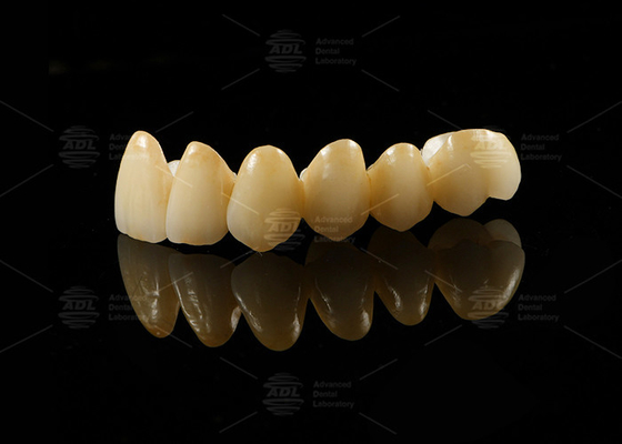 kopen Sterk esthetisch porselein gesmolten met zirconia voor natuurlijke restauratie online vervaardiging