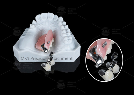 kopen MK1 Precision Attachment Afneembare gedeeltelijke tandheelkunde Gemakkelijke installatie online vervaardiging