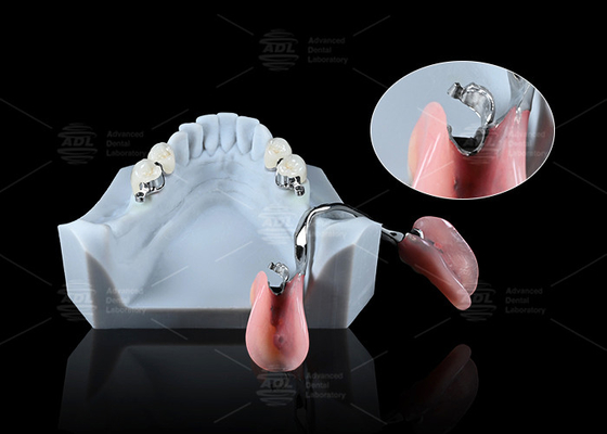 kopen Sleek Precision ERA tandheelkundige bevestigingen voor universele veilige tandheelkundige prothesen online vervaardiging