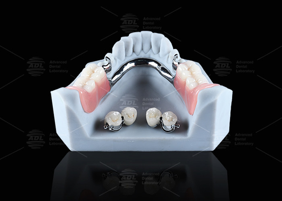 kopen Titanium tandheelkundige implantaten bal bevestigingen Comfortabele veilige tandheelkundige retentie online vervaardiging