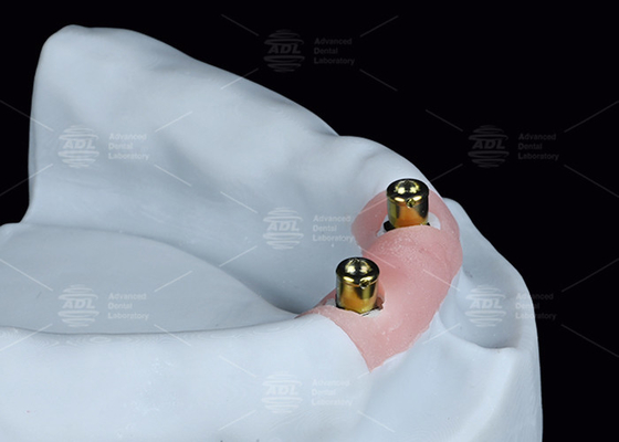 kopen Overprothese Locator Aanhangsels Titanium Bracket Locator Prothese Aanhangsels online vervaardiging