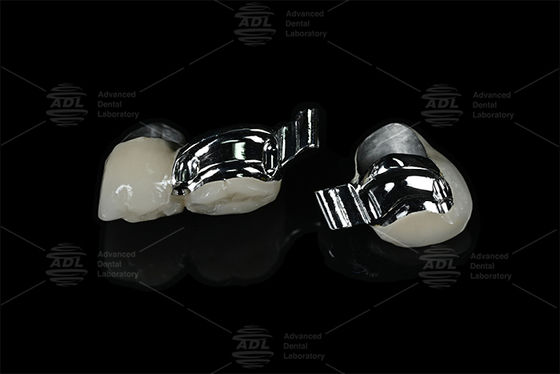 kopen China tandheelkundige laboratorium verstelbare patiënt-specifieke sleutelsluiting met PFM online vervaardiging