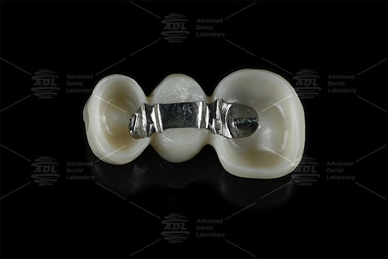kopen Aanpasbare versterkte titaniumstaaf gecombineerd met gefreesd zirconia die tandheelkundige implantaten biedt online vervaardiging