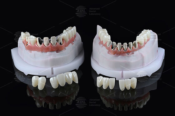 kopen China Tandheelkundig Laboratorium Titanium Volledige Boog Hybride Brug met Onmiddellijke Belasting A1 Kleur Malong Ontwerp Schroefvast Cad/Cam online vervaardiging