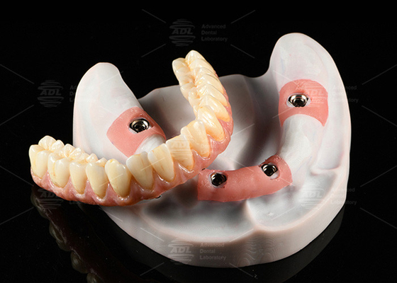 Composite Pink Porcelain Crown A1 Shade All On 4 Hybride Titanium Schroef behouden