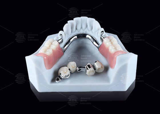 CEKA M2 Precision Attachment Titanium met 3 mm horizontale / verticale openingen