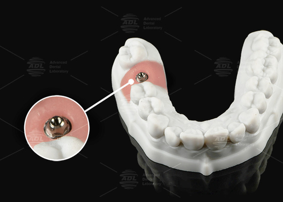Zilvergoud Titanium Multi Unit Abutment voor een of meerdere eenheden prothetisch platform