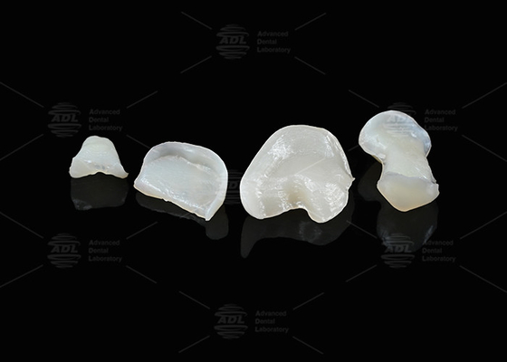 Translucent Onlay Zirconia Inlay voor langdurige vlek- en slijtvastheid