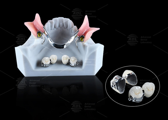 CE FDA Bal bevestigingsprothesen Comfortabel Prothese Bal bevestigingsprothesen Langdurig