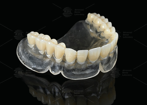 Warmtebestendige Vertex Thermosens Prothesen voor zichtbare volledige prothese dragers
