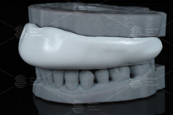 Behoorlijk Occlusal Splint Sport Guard Bijt Splint Design Makkelijk te reinigen Comfortabel beschermingsapparaat voor tandenknijpen